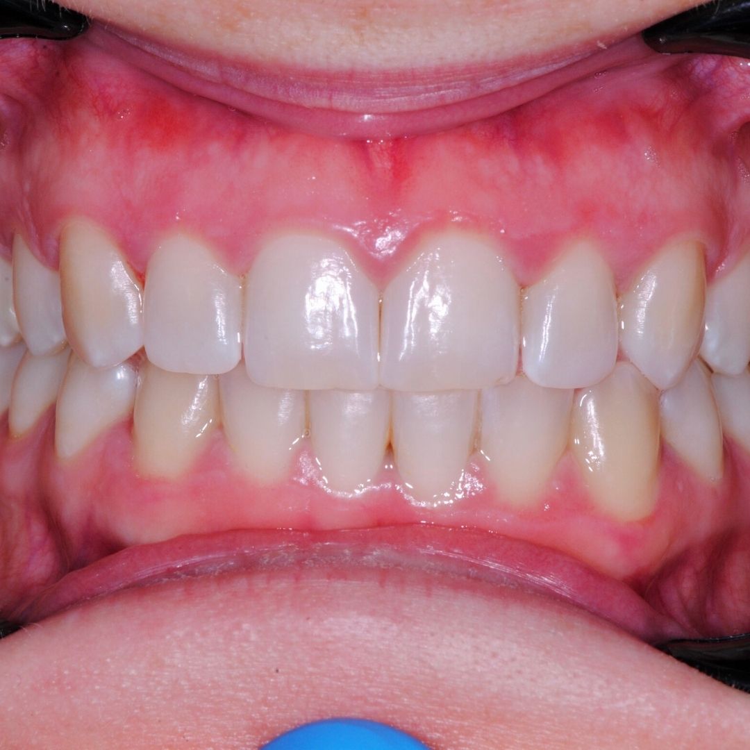resultados tratamientos ortodoncia